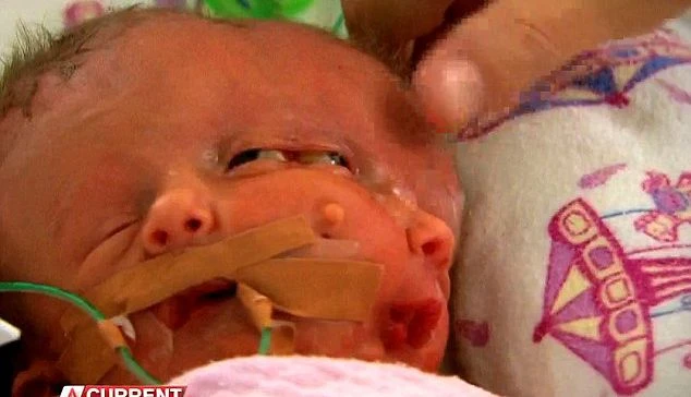 Siamesische Zwillinge