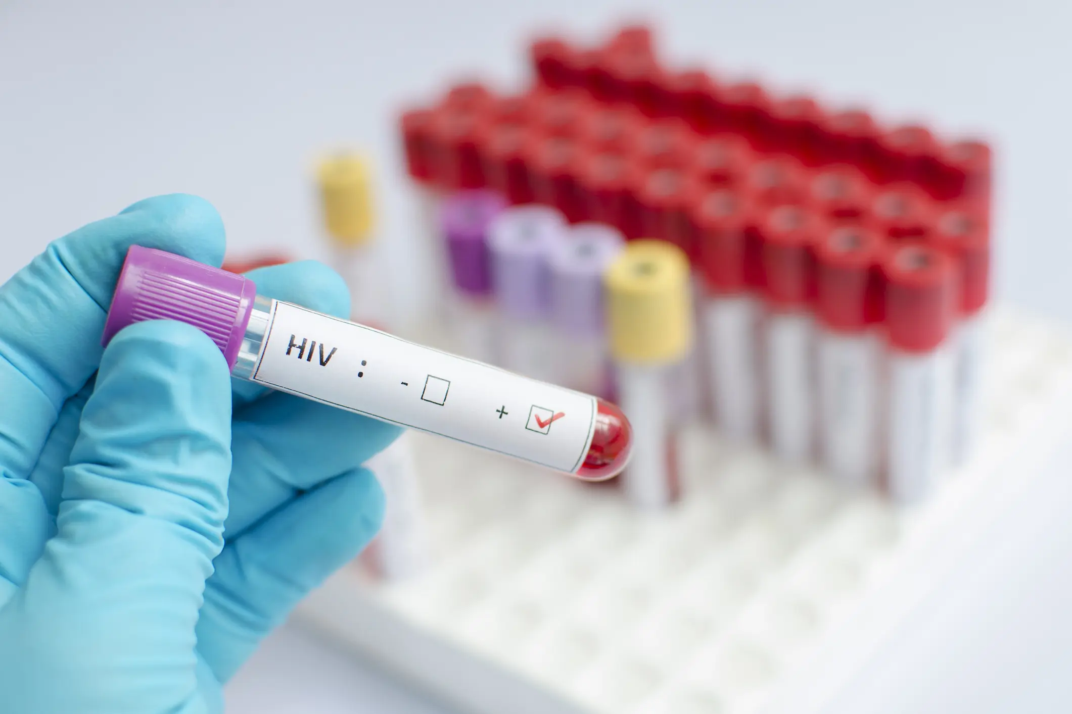 HIV