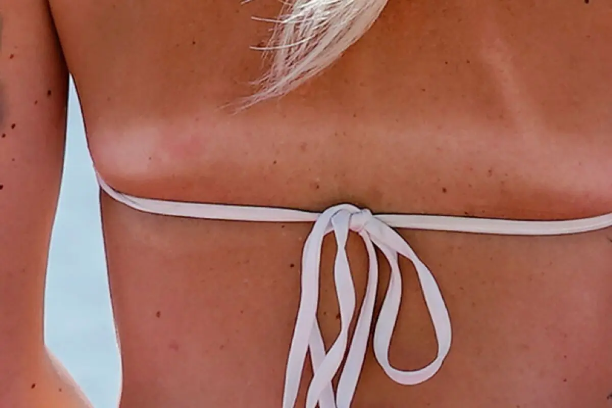 ++ ARCHIVBILD ++ Mit gebräunter Haut im Sommer verbinden viele etwas Positives