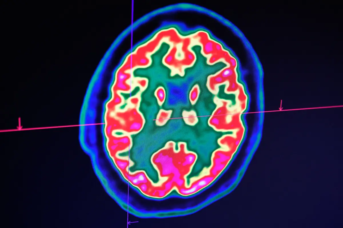 Einer von vier Erwachsenen erleidet einen Schlaganfall