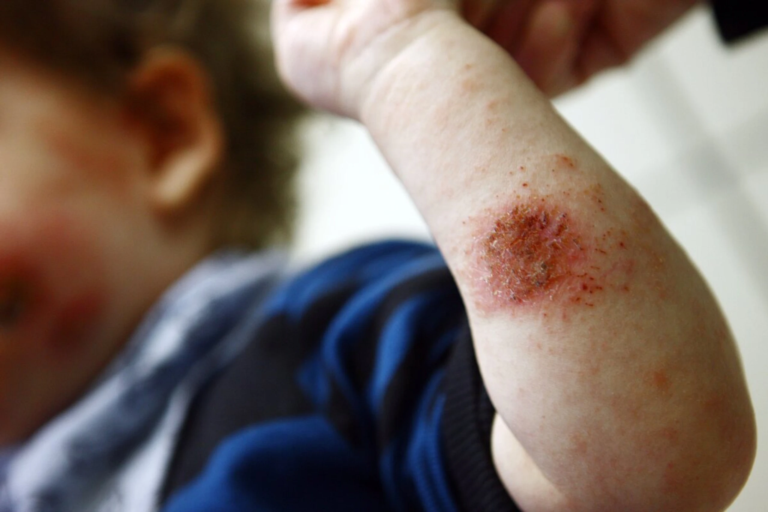 Wenig Therapien für chronisch entzündliche Hautkrankheiten