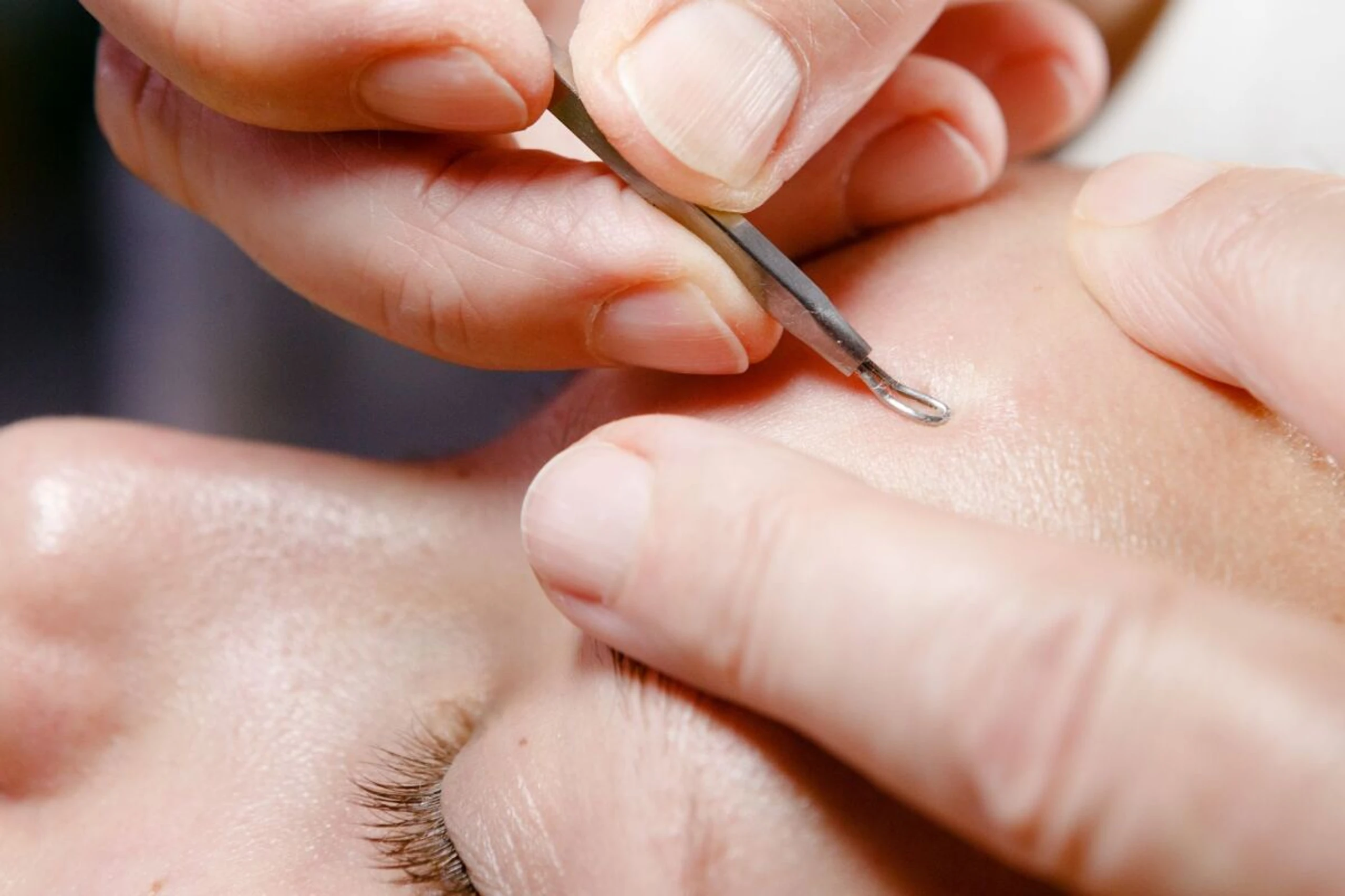 Bei hartnäckigen Hautunreinheiten sollte man Profis ranlassen