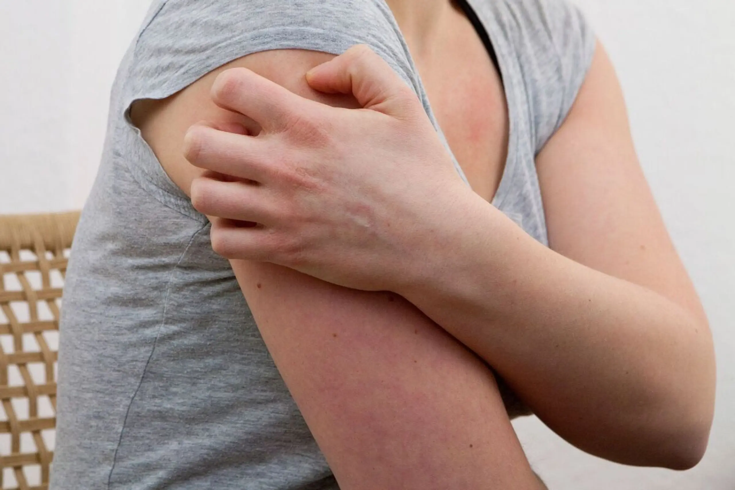 Dem Auslöser einer Nesselsucht auf die Spur zu kommen, ist schwer