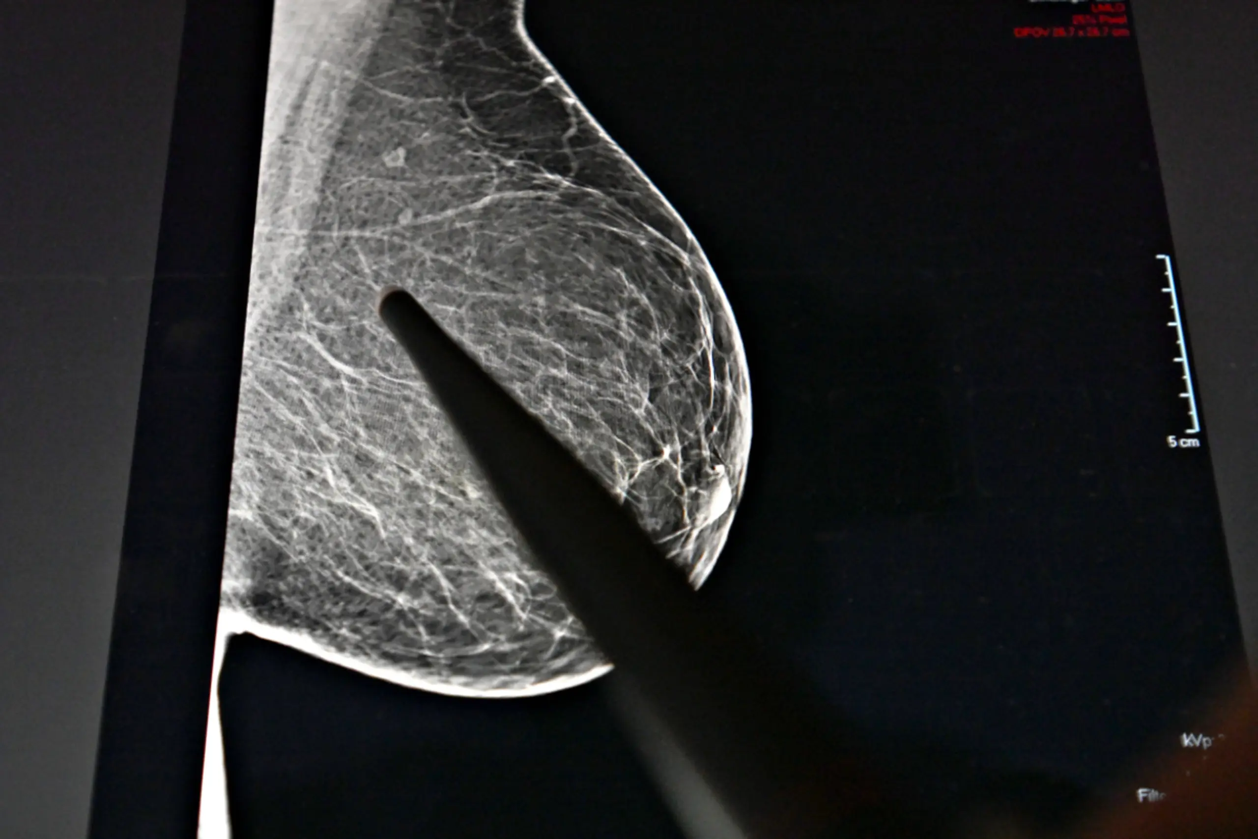 Früherkennung von Brustkrebs ist essenziell