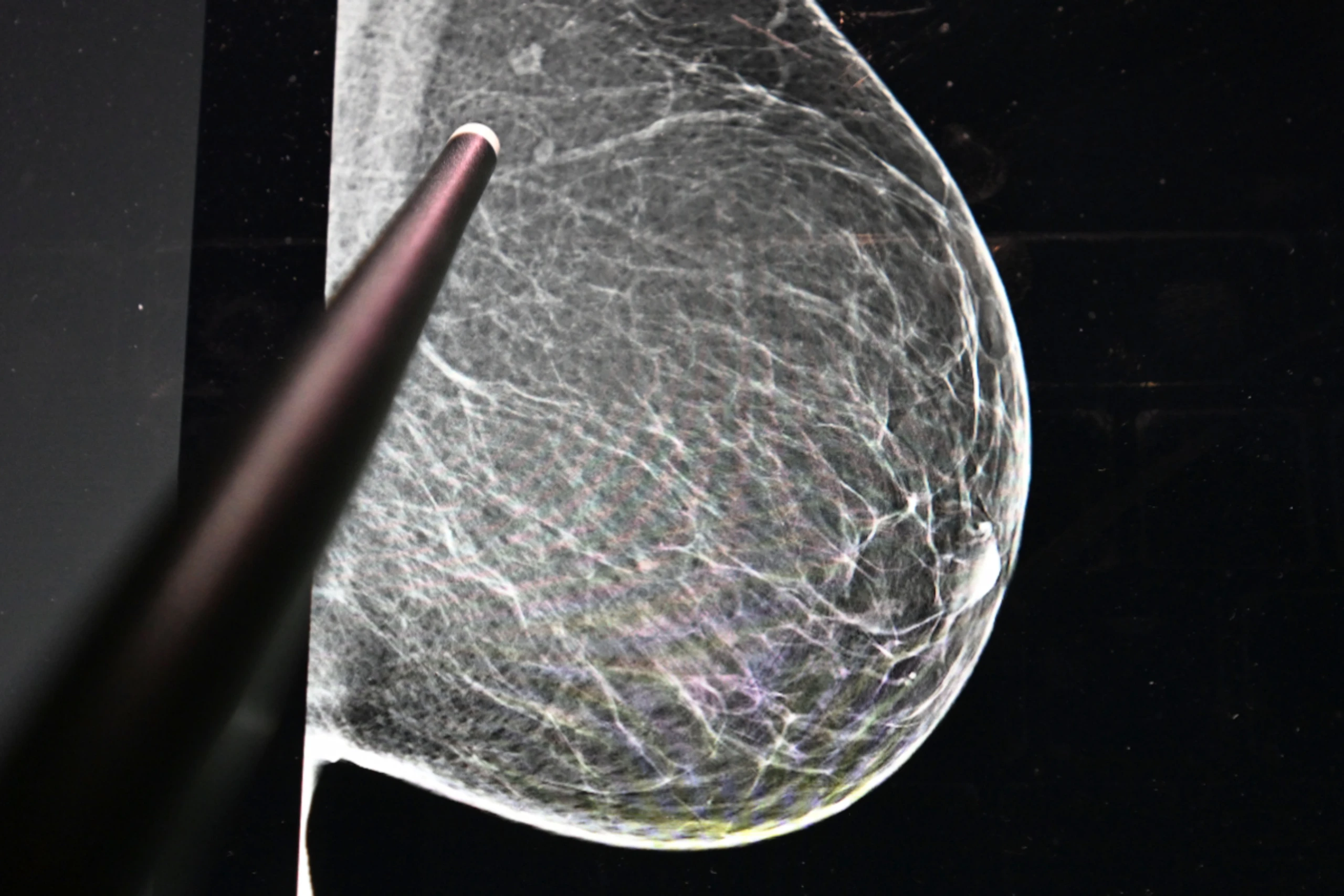 Die Zahl der Brustkrebs Erkrankten steigt weltweit an