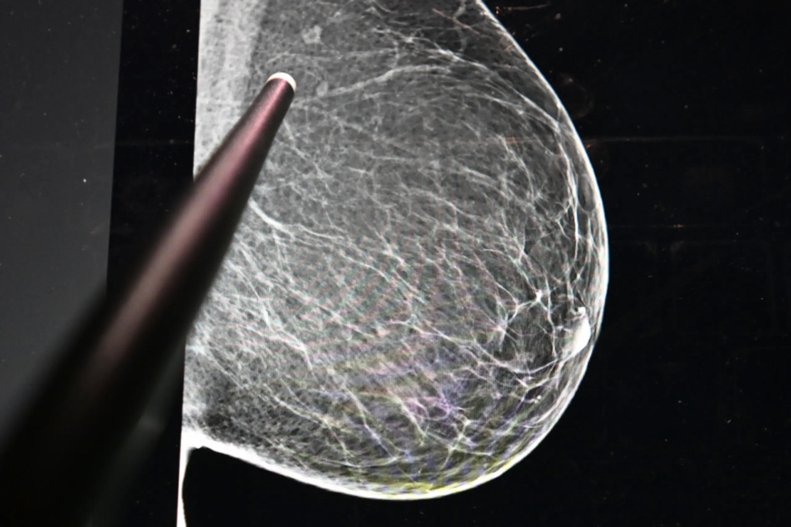 75 Prozent der Hilfesuchenden bei der Krebshilfe sind Frauen