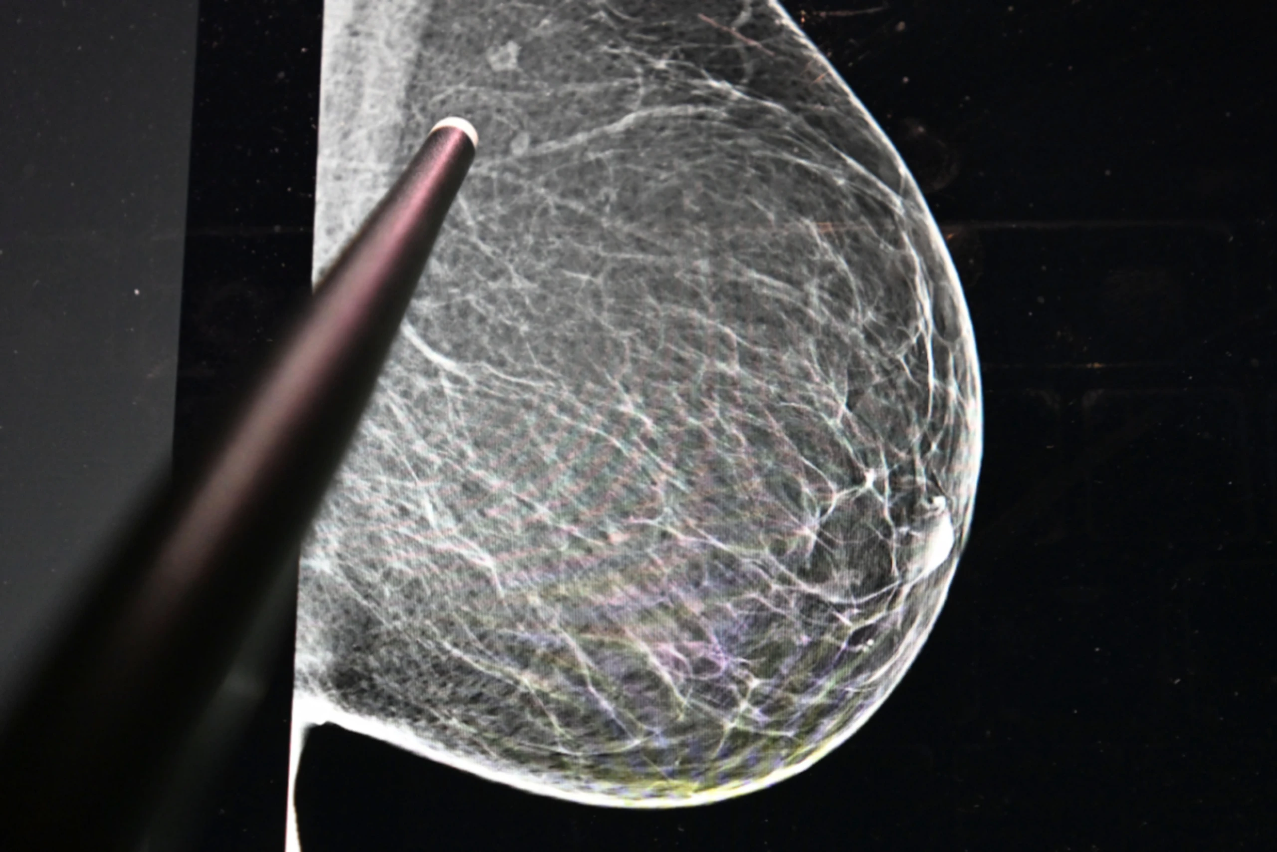 75 Prozent der Hilfesuchenden bei der Krebshilfe sind Frauen