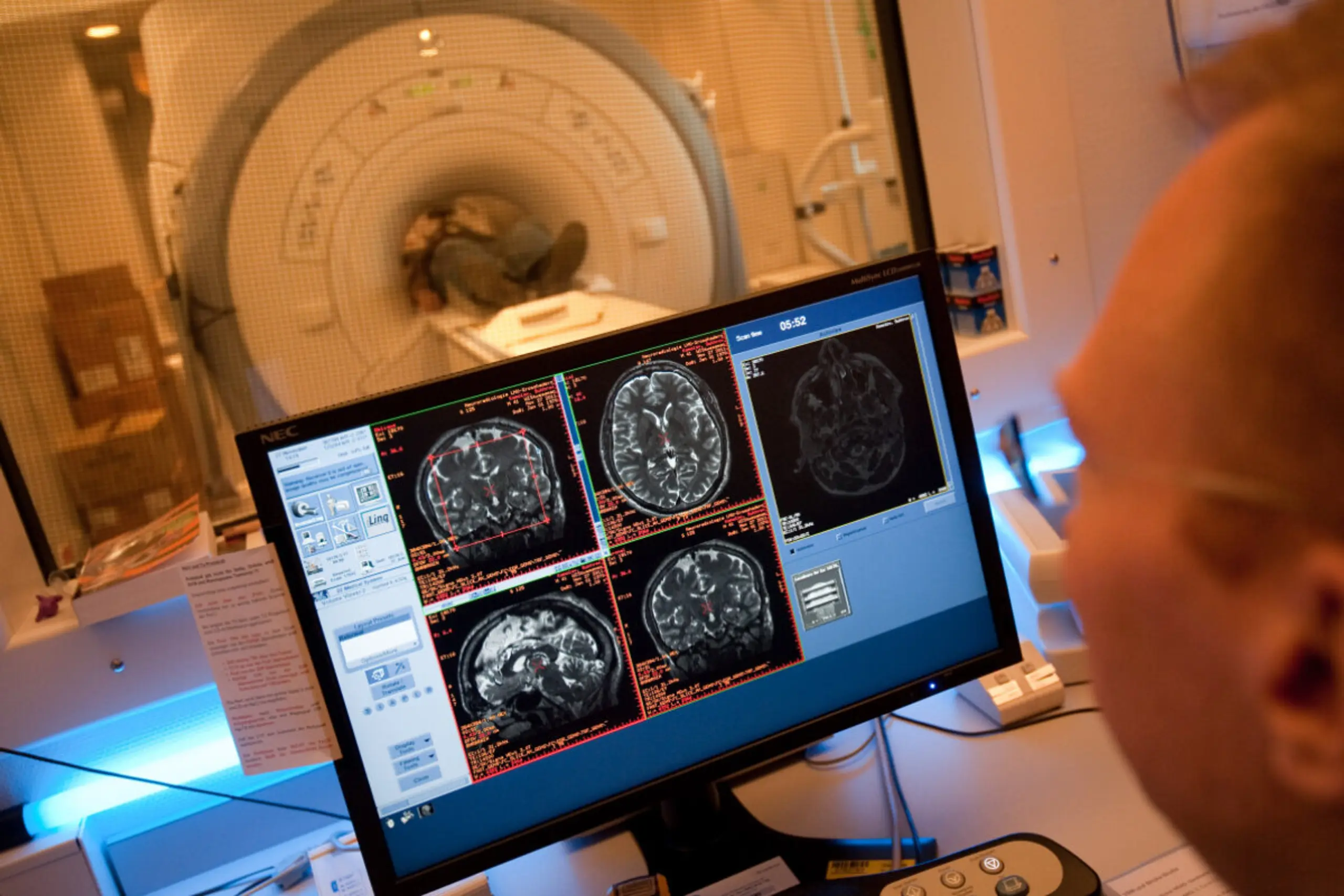 Eine Gehirn-Computer-Schnittstelle soll in den Verkauf kommen