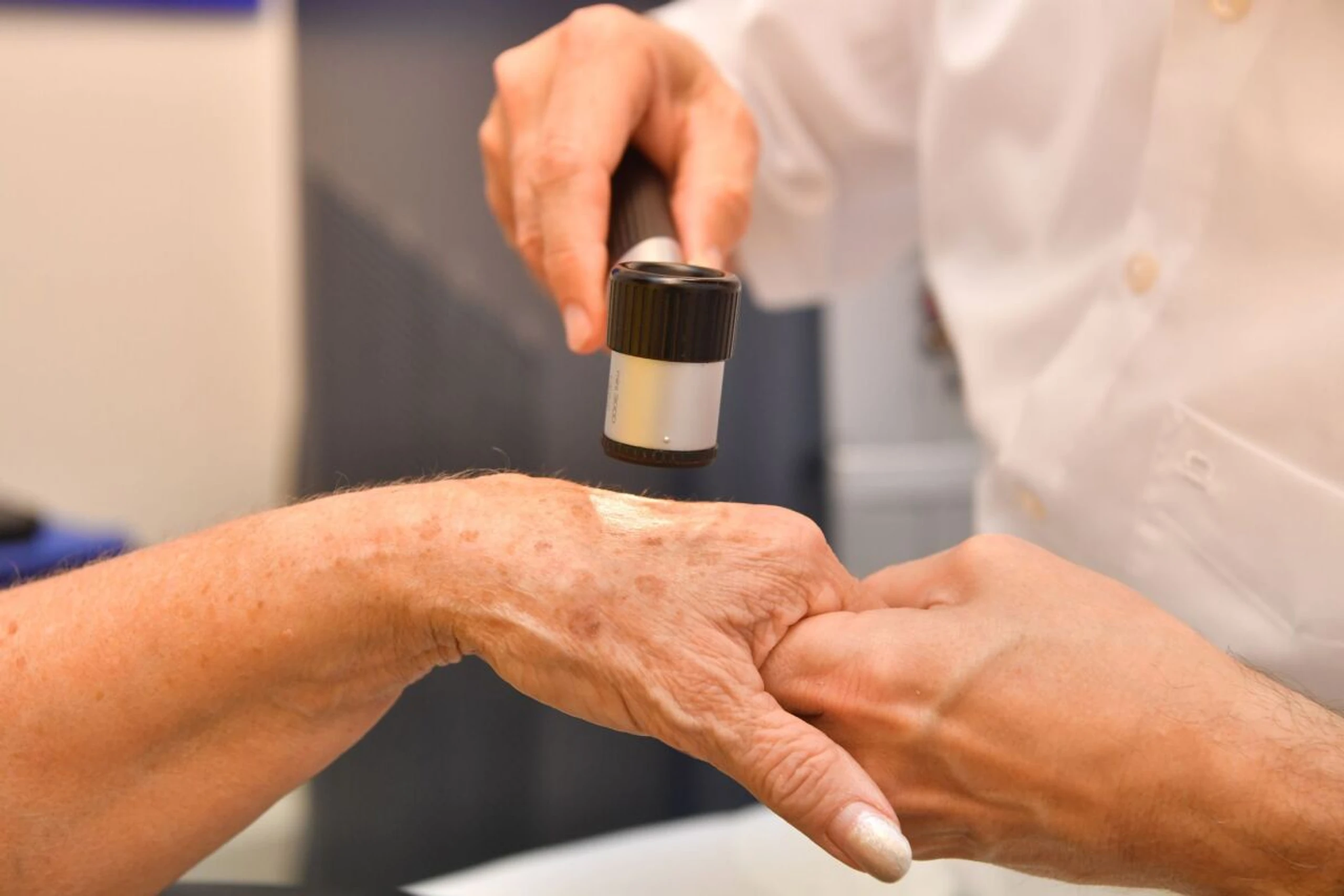 ++ ARCHIVBILD ++ Dermatologen bieten diverse Methoden an, um Altersflecken zu entfernen