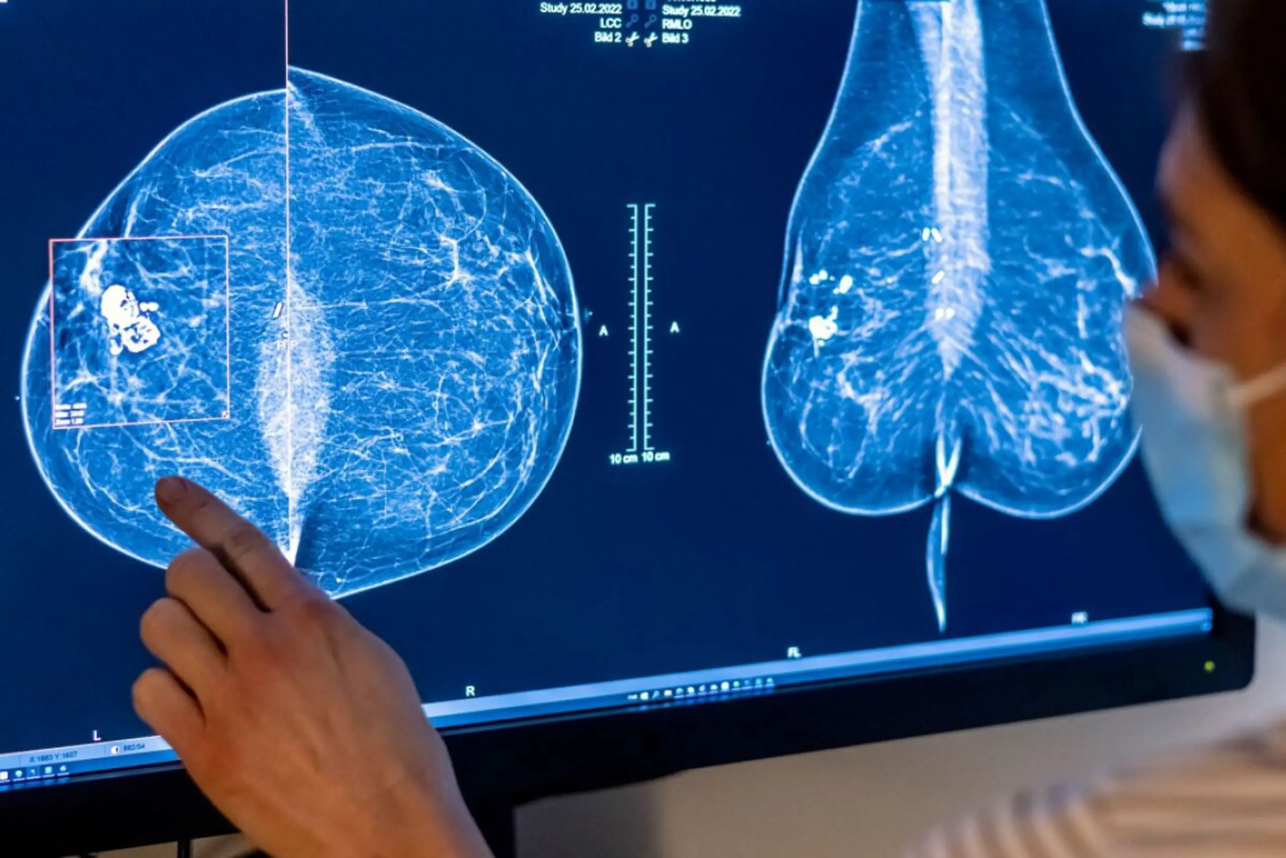 ++ ARCHIVBILD ++ Mammografie: Die häufigste bildgebende Früherkennungsuntersuchungen