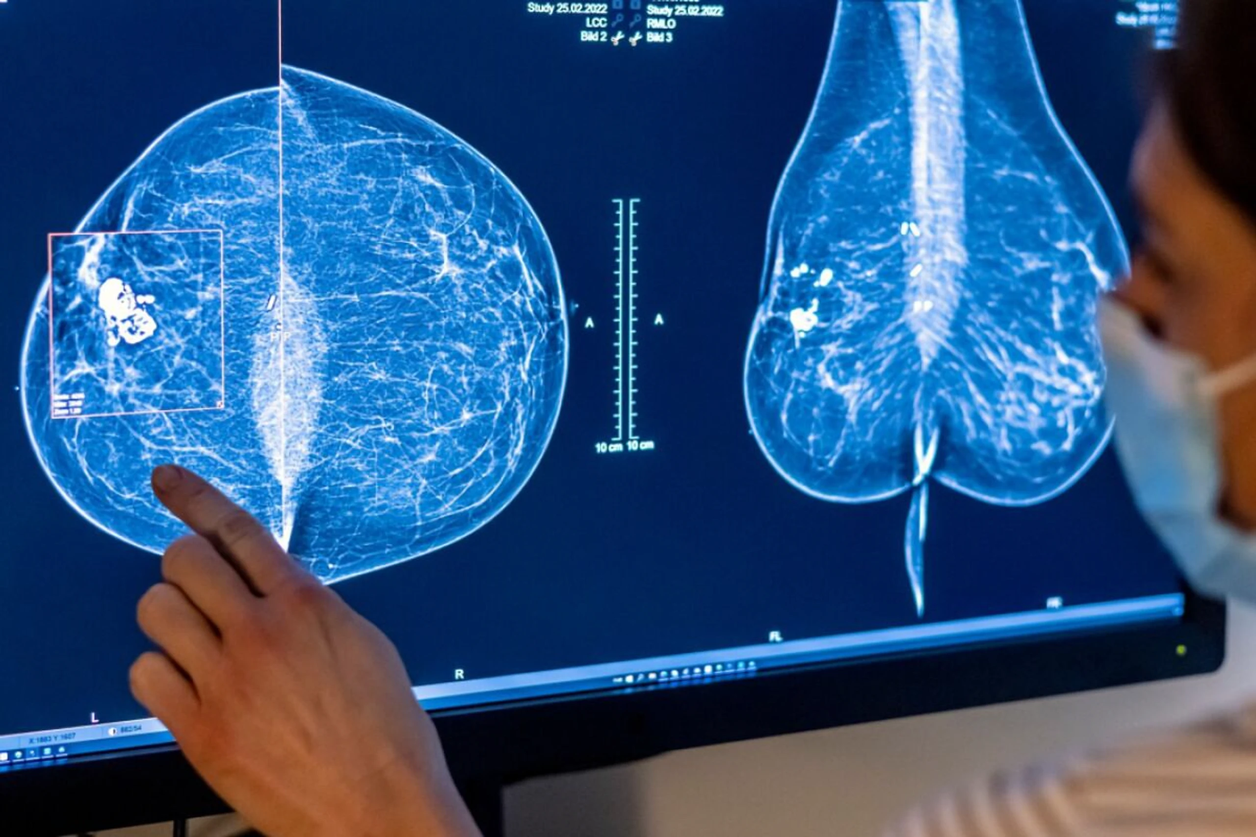 ++ ARCHIVBILD ++ Mammografie: Die häufigste bildgebende Früherkennungsuntersuchungen