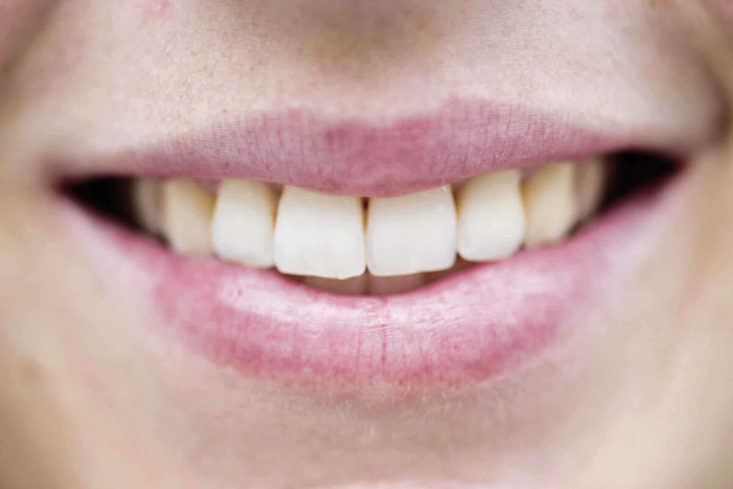Elf Do-it-yourself-Produkte fürs Zahnbleaching getestet