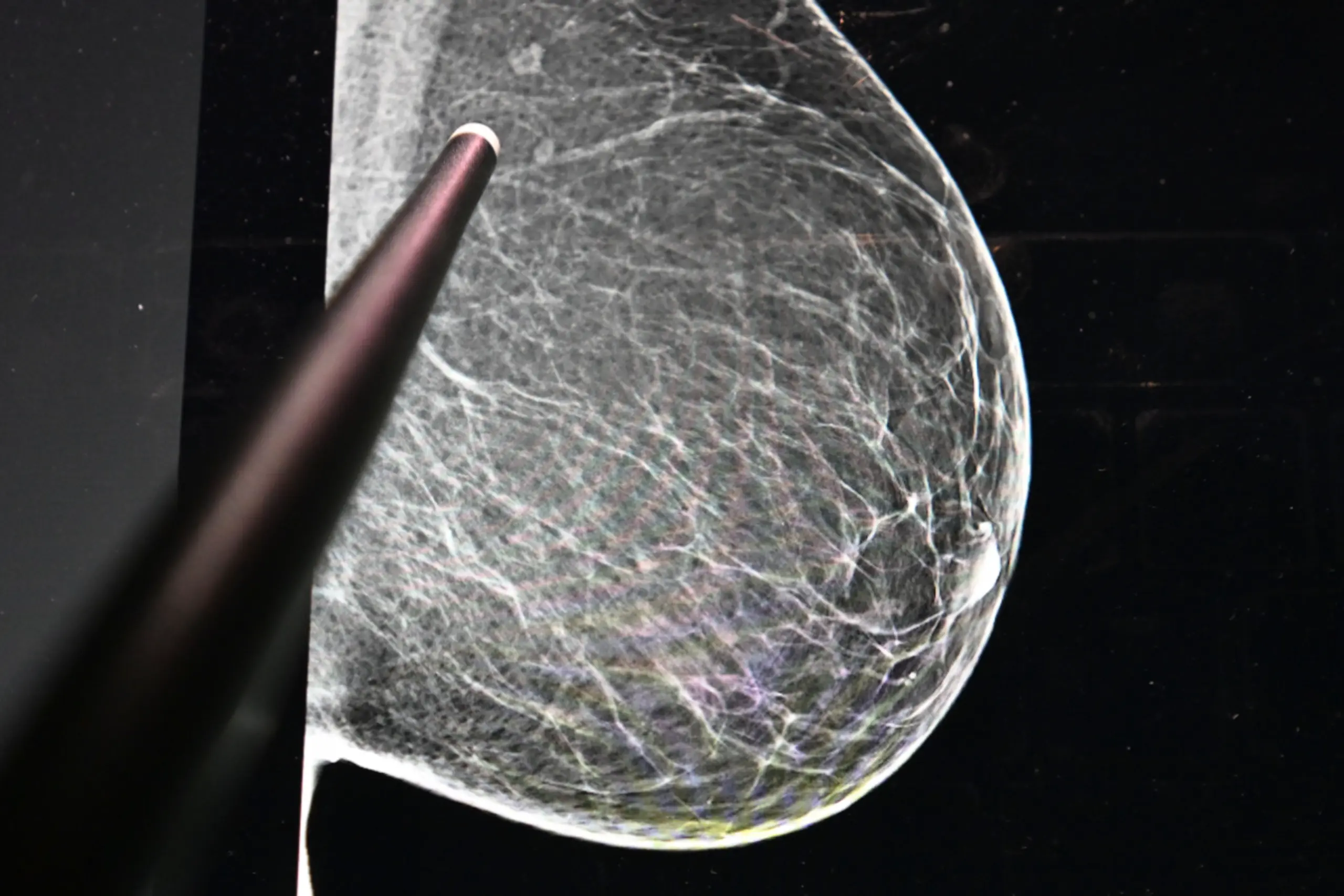 Mammografie